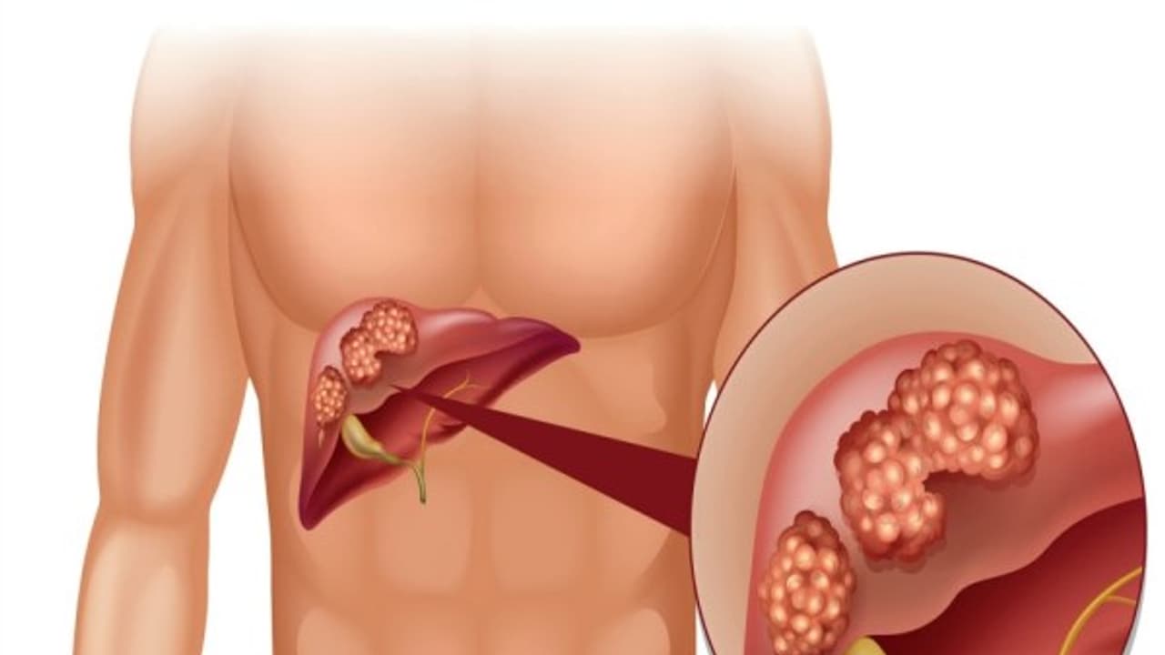 உங்களுக்குத் தெரியுமா? குரல் கரகரப்பாக இருப்பதுகூட இந்த புற்றுநோயின் அறிகுறிதான்... உங்களுக்குத் தெரியுமா? குரல் கரகரப்பாக இருப்பதுகூட இந்த புற்றுநோயின் அறிகுறிதான்...