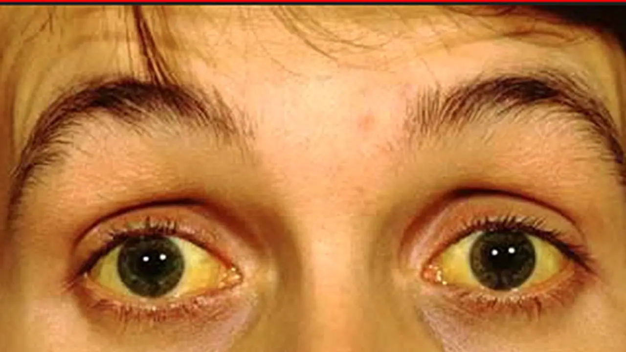 Health Tips শরীরে বিলিরুবিনের পরিমাণ বৃদ্ধি, জেনে নিন জন্ডিসের লক্ষণ ও কারণ Health Tips শরীরে বিলিরুবিনের পরিমাণ বৃদ্ধি, জেনে নিন জন্ডিসের লক্ষণ ও কারণ