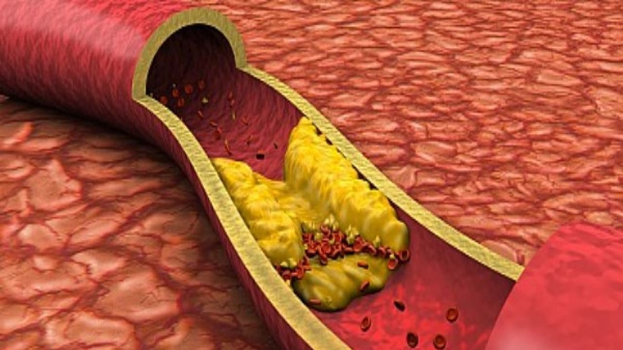 இதற்கு பதில் தெரியுமா? இரத்த குழாய்களில் தேங்கியுள்ள கொழுப்பை கரைக்க உதவுவது எது? 