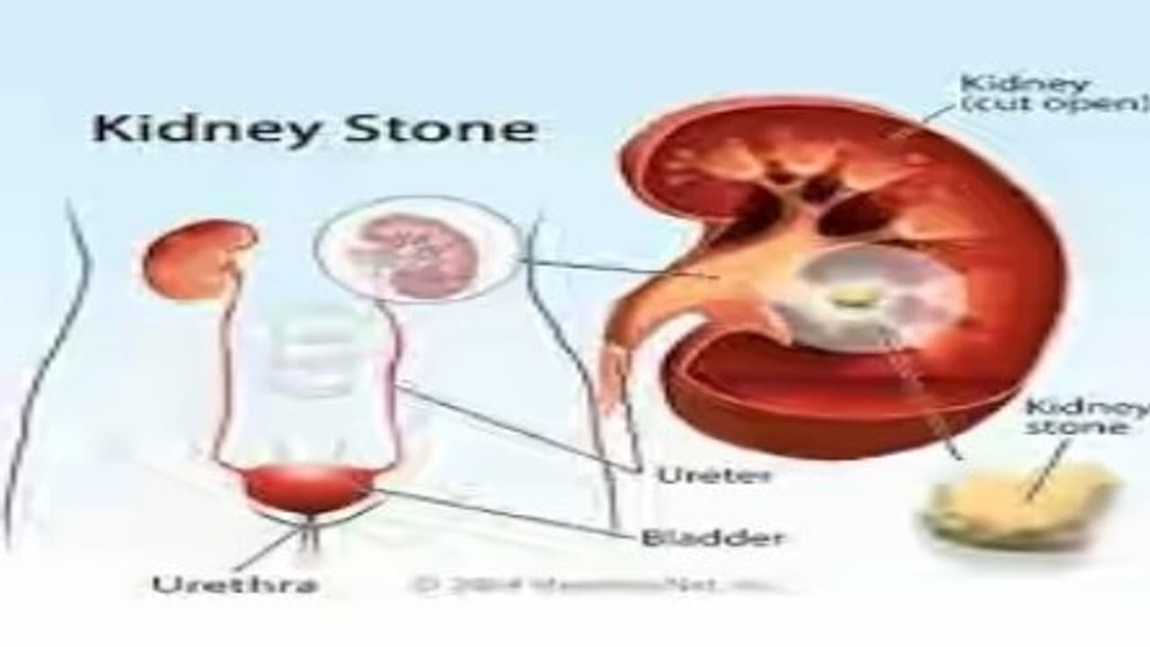 கிட்னியில் கல்லா? பூளைப்பூ வைத்தியம் இருக்கு கவலை எதுக்கு? கிட்னியில் கல்லா? பூளைப்பூ வைத்தியம் இருக்கு கவலை எதுக்கு?