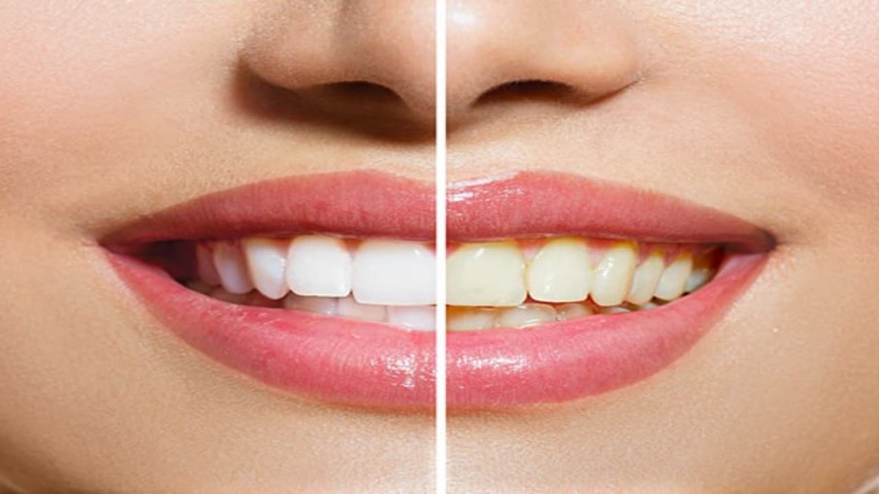 பற்களில் இருக்கும் கறைகளை விரட்ட இதோ டிப்ஸ்…