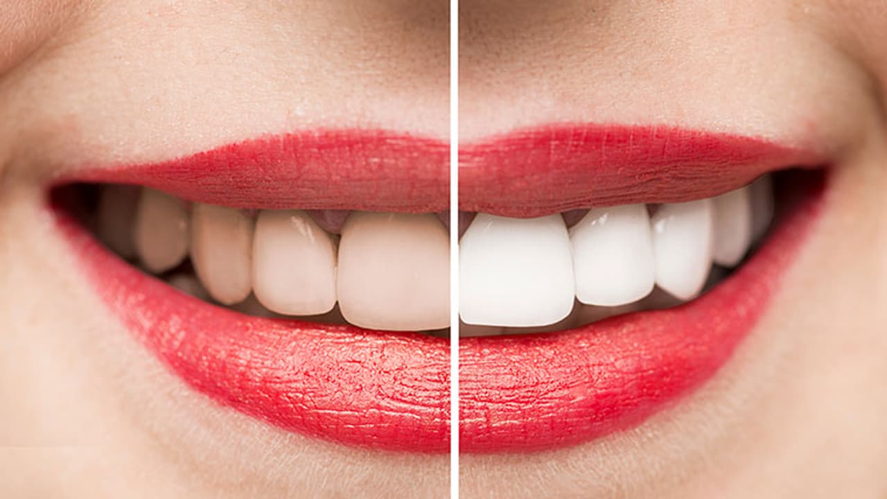 5 teeth whitening hacks that you can do at home