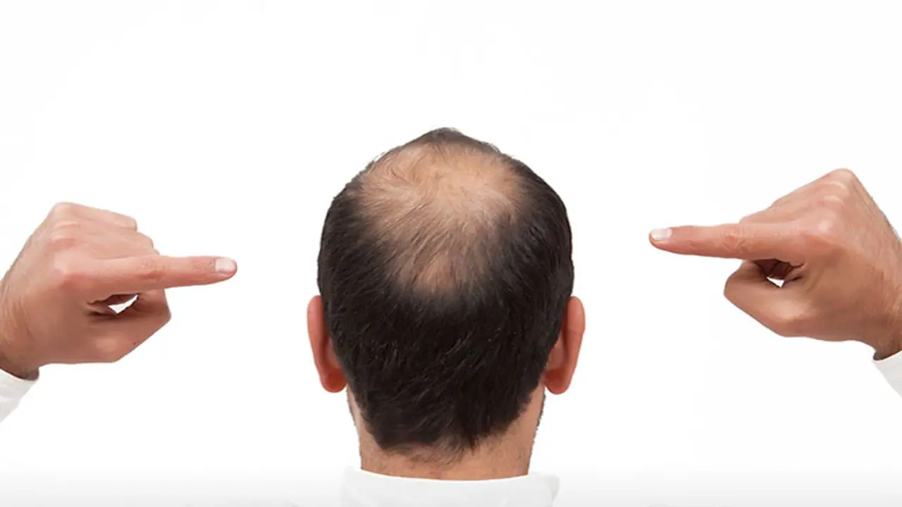 ಬೊಕ್ಕತಲೆಗೂ ಇದು ಕಾರಣವೇ? ಬೊಕ್ಕತಲೆಗೂ ಇದು ಕಾರಣವೇ?