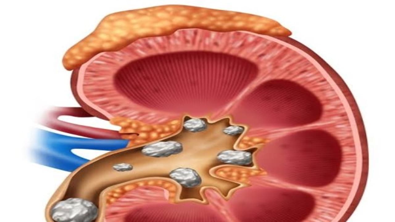 இந்த பழங்களைக் கொண்டு ஜூஸ் தயாரித்து குடித்தால் சிறுநீரக கற்கள் கரையும்... இந்த பழங்களைக் கொண்டு ஜூஸ் தயாரித்து குடித்தால் சிறுநீரக கற்கள் கரையும்...