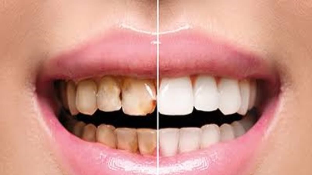 பற்களில் இருக்கும் காரையை எளிதாக போக்க இந்த எளிய முறை பயன்படுத்திதான் பாருங்களேன்... பற்களில் இருக்கும் காரையை எளிதாக போக்க இந்த எளிய முறை பயன்படுத்திதான் பாருங்களேன்...