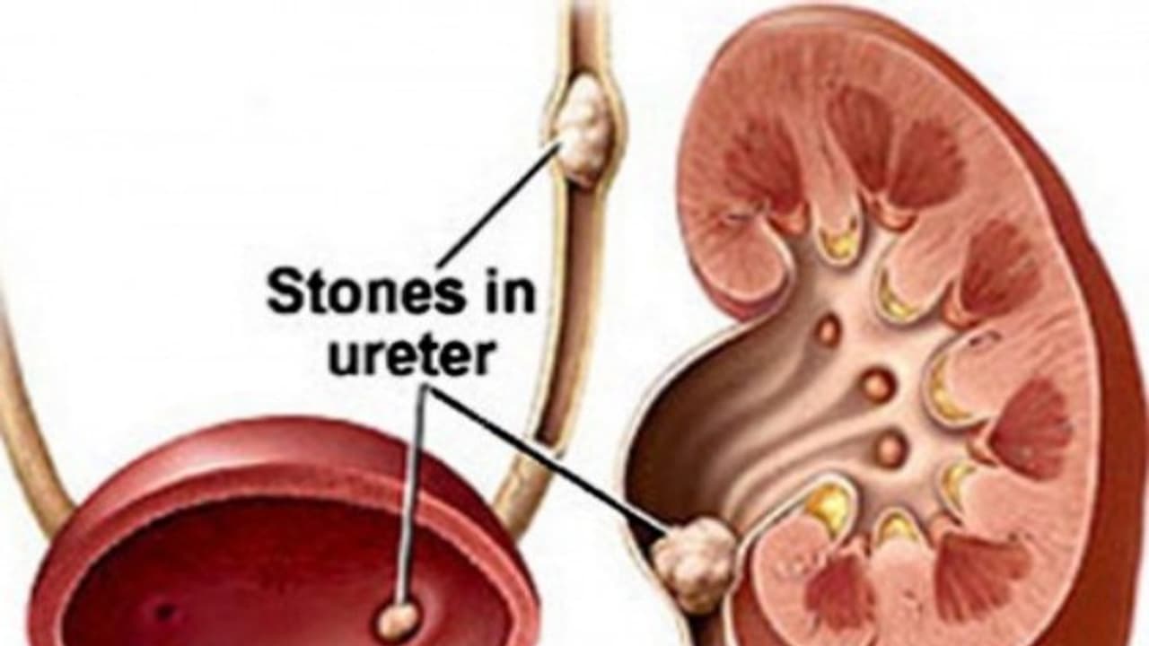 கிட்னியில் கல் வராமல் இருக்க நிறைய காய்கறிகளை சாப்பிடுங்கள் அது போதும்...
