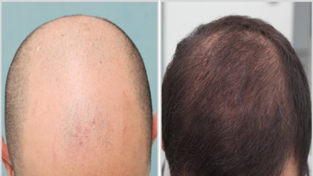 இந்த இயற்கை சிகிச்சையின் மூலம் வழுக்கைத் தலையிலும் முடி வளரச் செய்யலாம்...