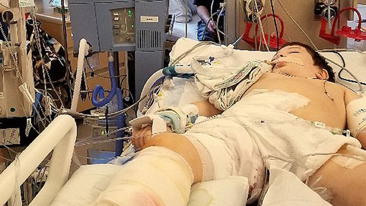 എട്ട് വയസുകാരന്റെ ജീവനെടുത്ത് മാംസം ഭക്ഷിക്കുന്ന ബാക്ടീരിയ എട്ട് വയസുകാരന്റെ ജീവനെടുത്ത് മാംസം ഭക്ഷിക്കുന്ന ബാക്ടീരിയ