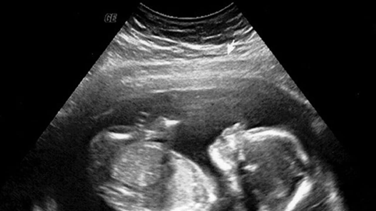 6 ವರ್ಷದ ಕಂದಮ್ಮನ ಹೊಟ್ಟೆಯಲ್ಲಿ ಪತ್ತೆಯಾಯಿತು ಸತ್ತ ಭ್ರೂಣ! 6 ವರ್ಷದ ಕಂದಮ್ಮನ ಹೊಟ್ಟೆಯಲ್ಲಿ ಪತ್ತೆಯಾಯಿತು ಸತ್ತ ಭ್ರೂಣ!