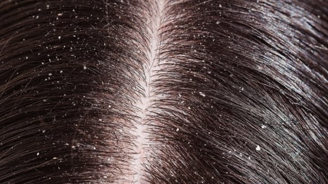 எளிதான இந்த வழிமுறைகளை பின்பற்றி பொடுகை விரட்டலாம்... எளிதான இந்த வழிமுறைகளை பின்பற்றி பொடுகை விரட்டலாம்...