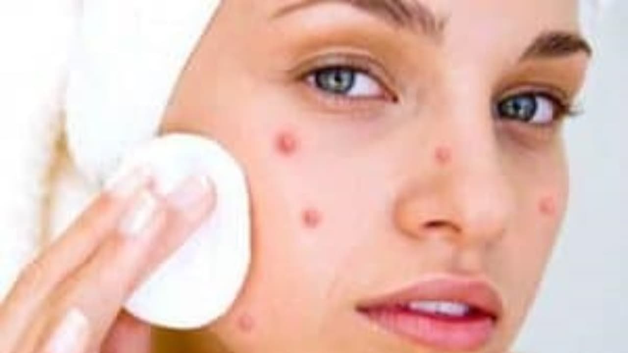 பெண்களின் அழகைக் கெடுக்கும் முகப்பருக்களை போக்க இதோ சூப்பர் டிப்ஸ்... பெண்களின் அழகைக் கெடுக்கும் முகப்பருக்களை போக்க இதோ சூப்பர் டிப்ஸ்...