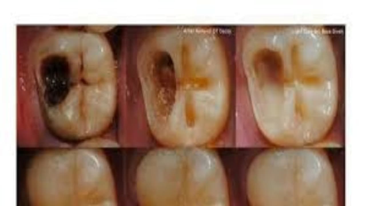 சொத்தை பற்களை ஆரம்பத்திலேயே கவனிக்காவிட்டால் ஆபத்துதான்; இந்த டிப்ஸை மறக்காமல் பின்பற்றுங்கள்... சொத்தை பற்களை ஆரம்பத்திலேயே கவனிக்காவிட்டால் ஆபத்துதான்; இந்த டிப்ஸை மறக்காமல் பின்பற்றுங்கள்...