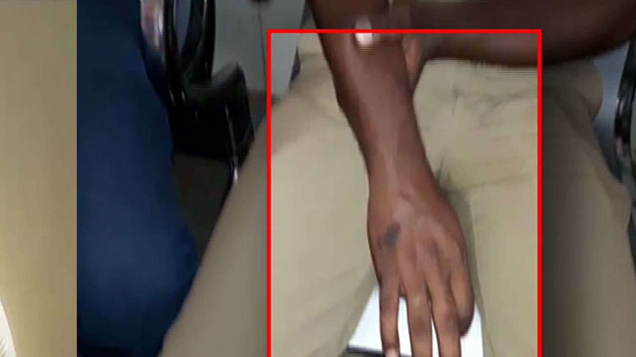 ಪಾಸ್ ಕೇಳಿದ ಕಂಡಕ್ಟರ್'ನ ಕೈ ಮುರಿದ ವಿದ್ಯಾರ್ಥಿ! ಪಾಸ್ ಕೇಳಿದ ಕಂಡಕ್ಟರ್'ನ ಕೈ ಮುರಿದ ವಿದ್ಯಾರ್ಥಿ!