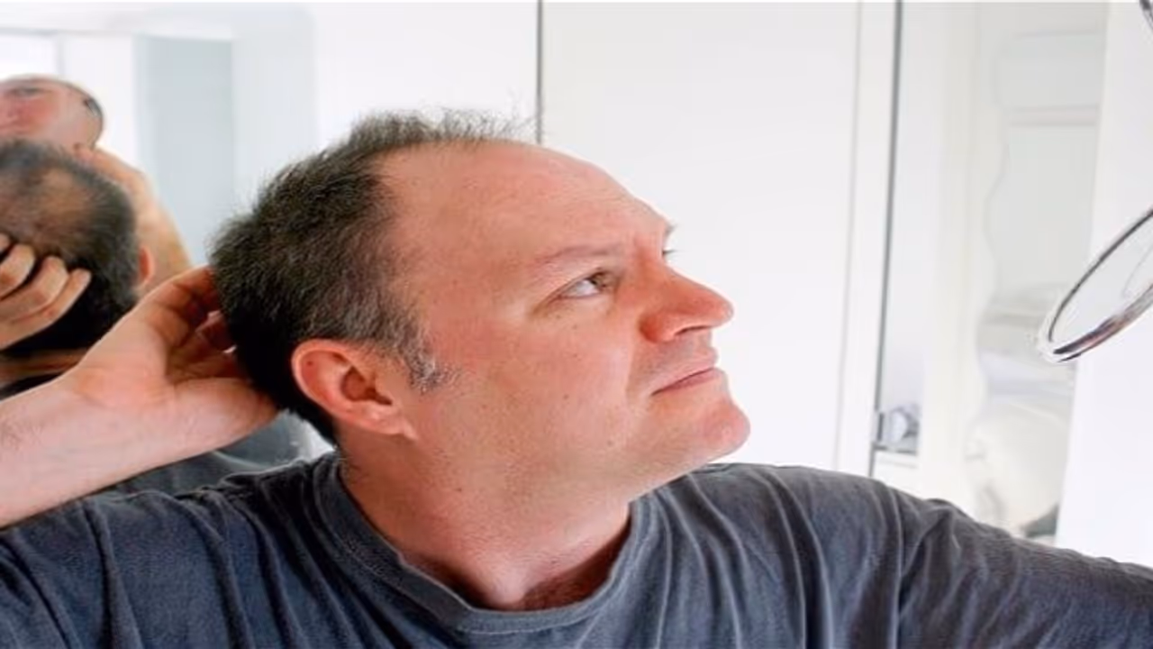 இந்த காரணங்களால் தான் ஆண்களுக்கு சொட்டை விழுகிறது… இந்த காரணங்களால் தான் ஆண்களுக்கு சொட்டை விழுகிறது…