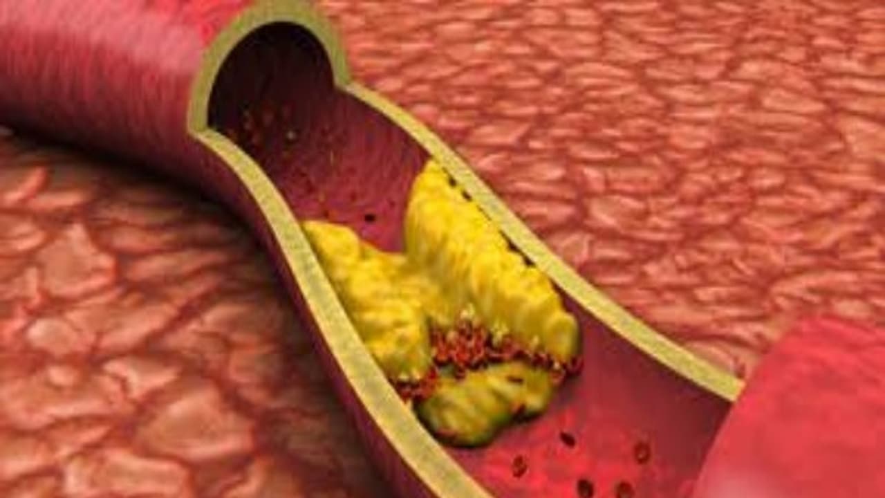 இரத்த குழாய் அடைப்பை போகும் ஒரு அருமருந்து இதோ… இரத்த குழாய் அடைப்பை போகும் ஒரு அருமருந்து இதோ…