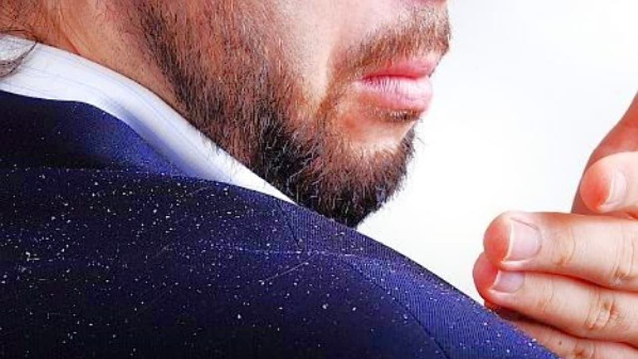 பொடுகு பிரச்சனையால் வெளியில் தலை காட்ட முடியலையா? வெங்காயச் சாறை கொண்டு குணமாக்கலாம் வாங்க... பொடுகு பிரச்சனையால் வெளியில் தலை காட்ட முடியலையா? வெங்காயச் சாறை கொண்டு குணமாக்கலாம் வாங்க...