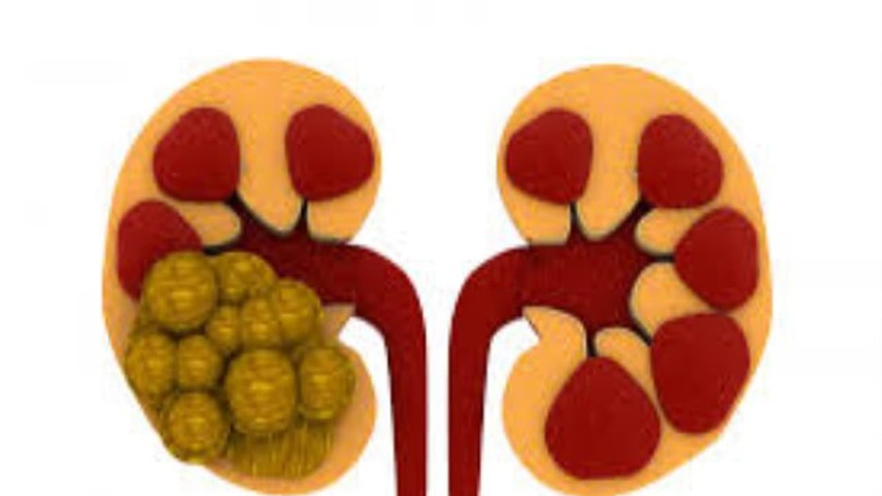 சிறுநீரகக் கற்களை நிரந்தரமாக கரைக்க இதோ ஓர் அற்புதமான வழி... சிறுநீரகக் கற்களை நிரந்தரமாக கரைக்க இதோ ஓர் அற்புதமான வழி...