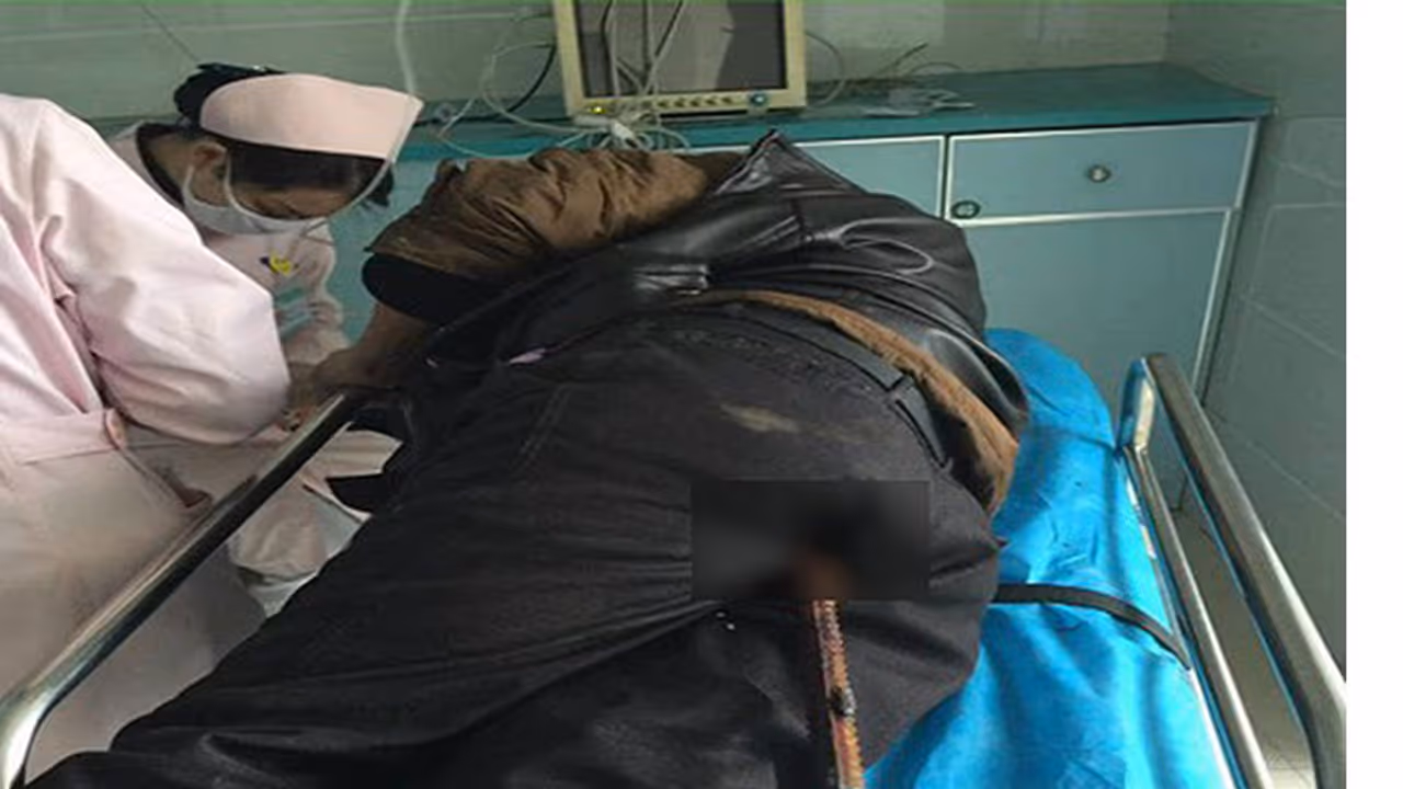 രഹസ്യഭാഗത്ത് ഇരുമ്പ് പാര തുളച്ചു കയറിയാള് അത്ഭുതകരമായ രക്ഷപ്പെട്ടു രഹസ്യഭാഗത്ത് ഇരുമ്പ് പാര തുളച്ചു കയറിയാള് അത്ഭുതകരമായ രക്ഷപ്പെട്ടു