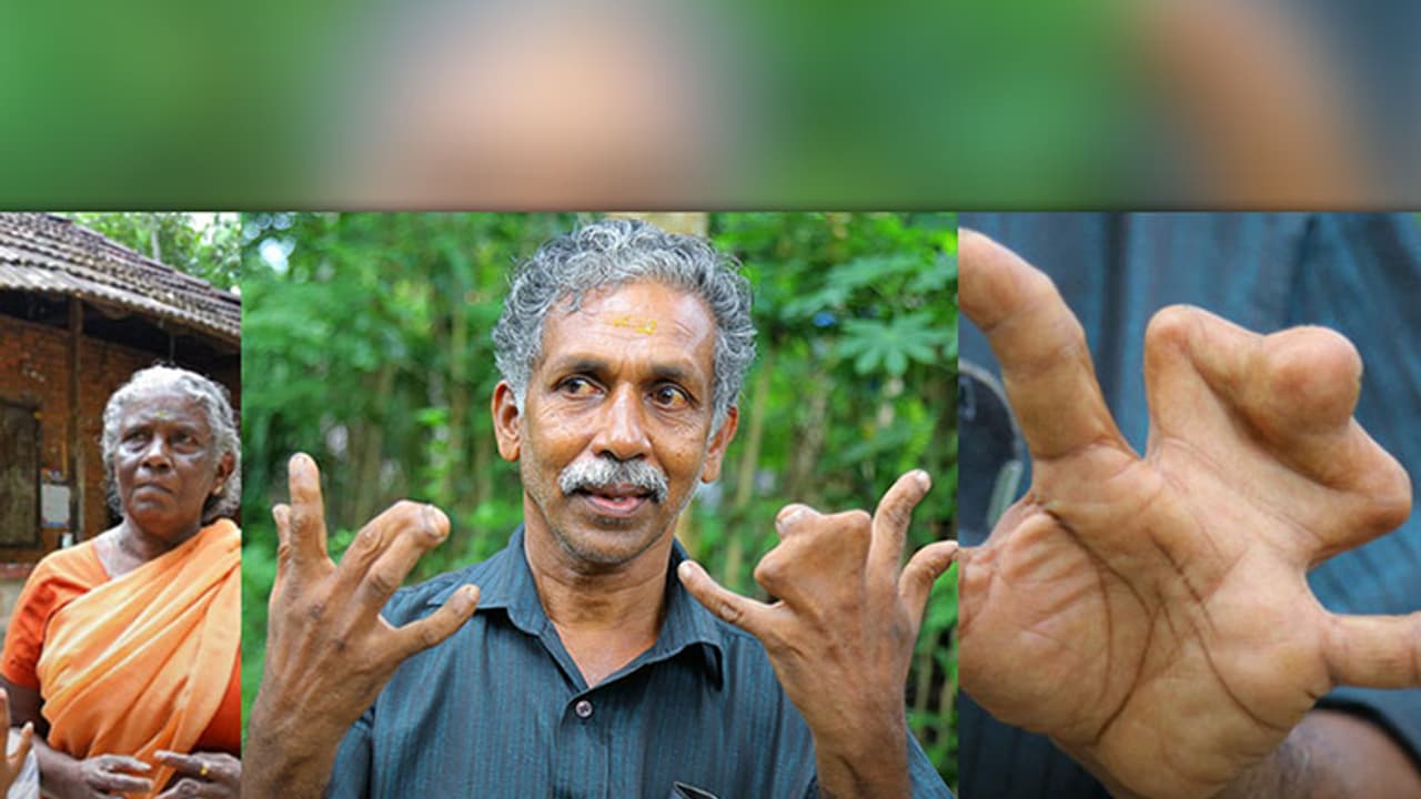 'Curse of snake Gods': Kerala family, with webbed fingers, refuses surgery [Video]