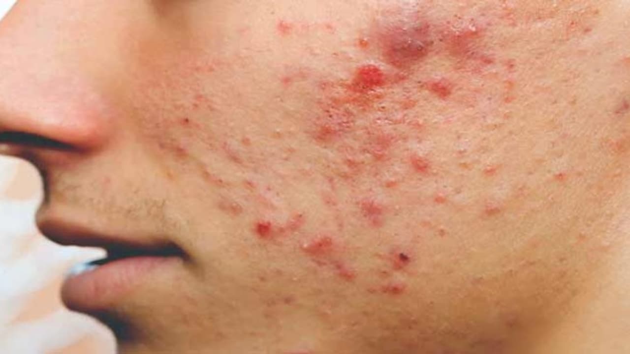 முகப்பருக்களால் வெளியில் தலை காட்ட முடியலையா? அப்போ இந்த டிப்ஸ் உங்களுக்கு… முகப்பருக்களால் வெளியில் தலை காட்ட முடியலையா? அப்போ இந்த டிப்ஸ் உங்களுக்கு…