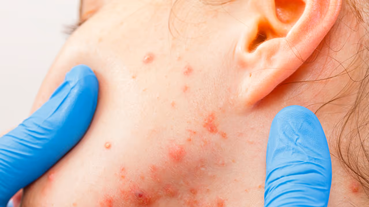 Skin Allergy: ಗುಟ್ಟು ಬಿಟ್ಟುಕೊಡದ ಚರ್ಮದ ಅಲರ್ಜಿ: ಈ ಐದು ಅಂಶಗಳೇ ಕಾರಣ Skin Allergy: ಗುಟ್ಟು ಬಿಟ್ಟುಕೊಡದ ಚರ್ಮದ ಅಲರ್ಜಿ: ಈ ಐದು ಅಂಶಗಳೇ ಕಾರಣ