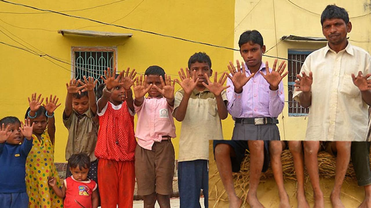 ಕೃಷ್ಣ ಚೌಧರಿ ಕುಟಂಬದ ಎಲ್ಲಾ ಸದಸ್ಯರಿಗೆ 24 ಬೆರಳುಗಳು! ಕೃಷ್ಣ ಚೌಧರಿ ಕುಟಂಬದ ಎಲ್ಲಾ ಸದಸ್ಯರಿಗೆ 24 ಬೆರಳುಗಳು!