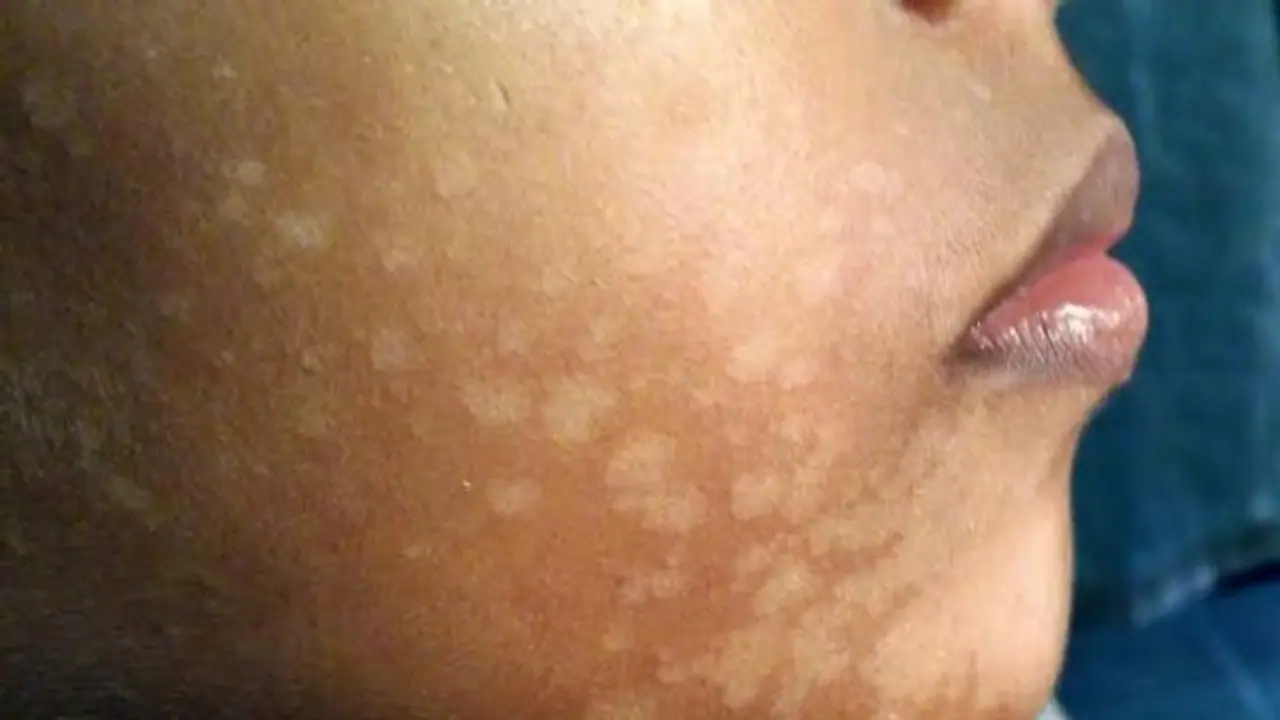 உடலில் அசிங்கமாக தெரியும் தேமலை குணப்படுத்த மூன்று இயற்கை வைத்திய முறைகள் இதோ... உடலில் அசிங்கமாக தெரியும் தேமலை குணப்படுத்த மூன்று இயற்கை வைத்திய முறைகள் இதோ...