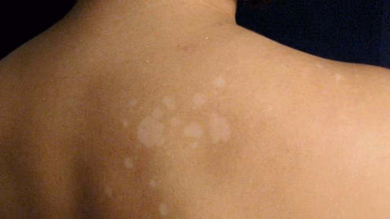 உடலில் அசிங்கமாக தெரியும் தேமல் மறைய இதை செய்து பாருங்களேன்... உடலில் அசிங்கமாக தெரியும் தேமல் மறைய இதை செய்து பாருங்களேன்...