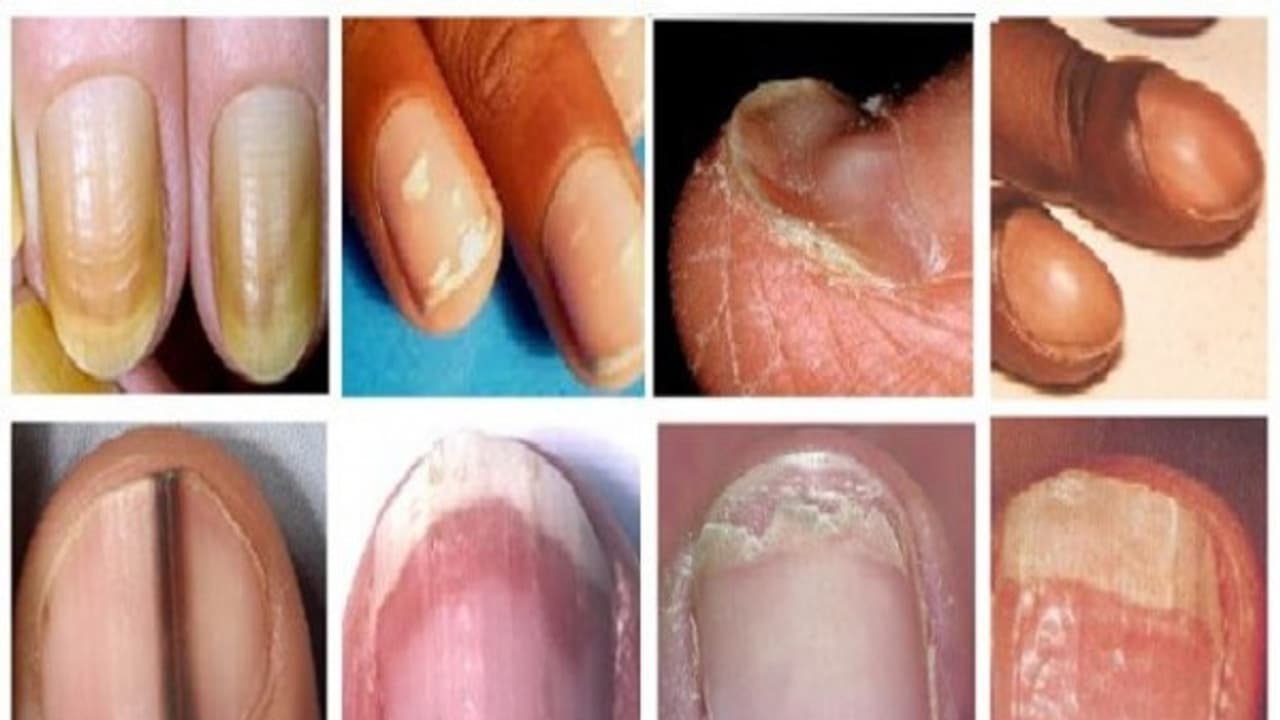 நீங்கள் ஆரோக்கியமாக இருக்கிறீர்களா? என்று உங்கள் நகங்கள் வைத்தே கண்டுபிடிக்கலாம். எப்படி? நீங்கள் ஆரோக்கியமாக இருக்கிறீர்களா? என்று உங்கள் நகங்கள் வைத்தே கண்டுபிடிக்கலாம். எப்படி?