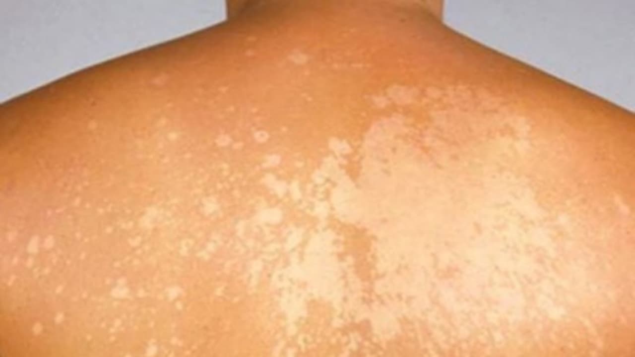 இந்த மூன்று முக்கிய பொருட்களை கொண்டு தேமலை குணப்படுத்தலாம்... இந்த மூன்று முக்கிய பொருட்களை கொண்டு தேமலை குணப்படுத்தலாம்...