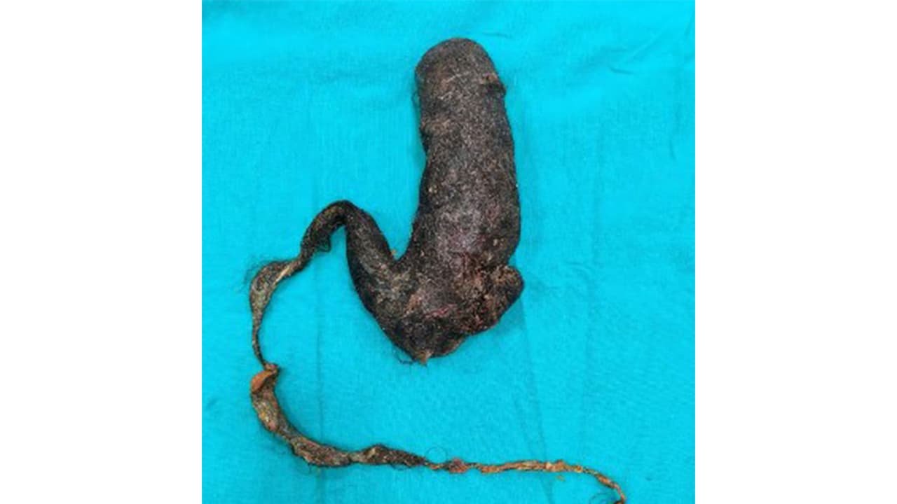 Hairball removed from woman's stomach (Photo/Amrita Hospital) Hairball removed from woman's stomach (Photo/Amrita Hospital)