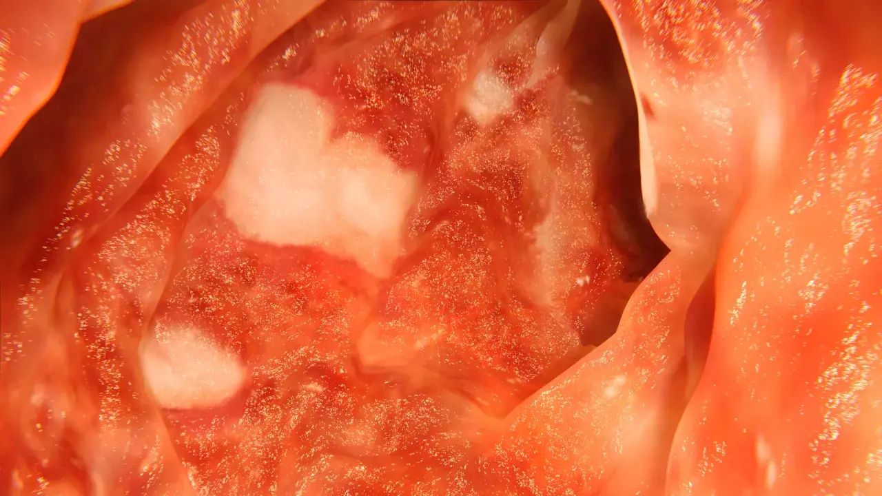 https://stocktwits.com/news articles/markets/equity/abivax spikes 460 percent on positive late stage ulcerative colitis drug trial results/ch8wSLiR5MQ