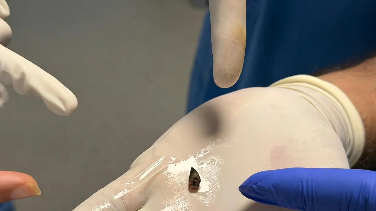 The tiny piece of betel nut removed from the child's airway (Photo/ANI) The tiny piece of betel nut removed from the child's airway (Photo/ANI)