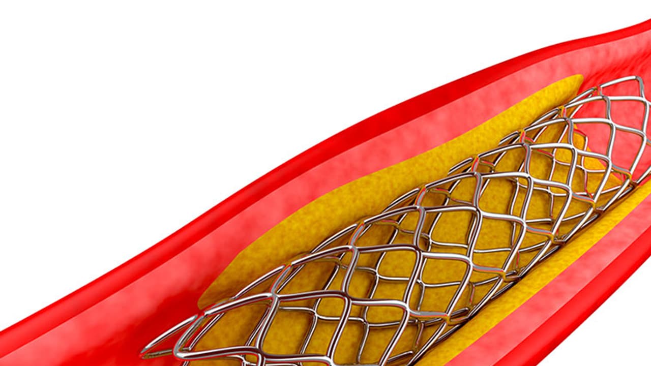Angioplasty stents cheaper now, but hospitals trick patients to deny benefit Angioplasty stents cheaper now, but hospitals trick patients to deny benefit