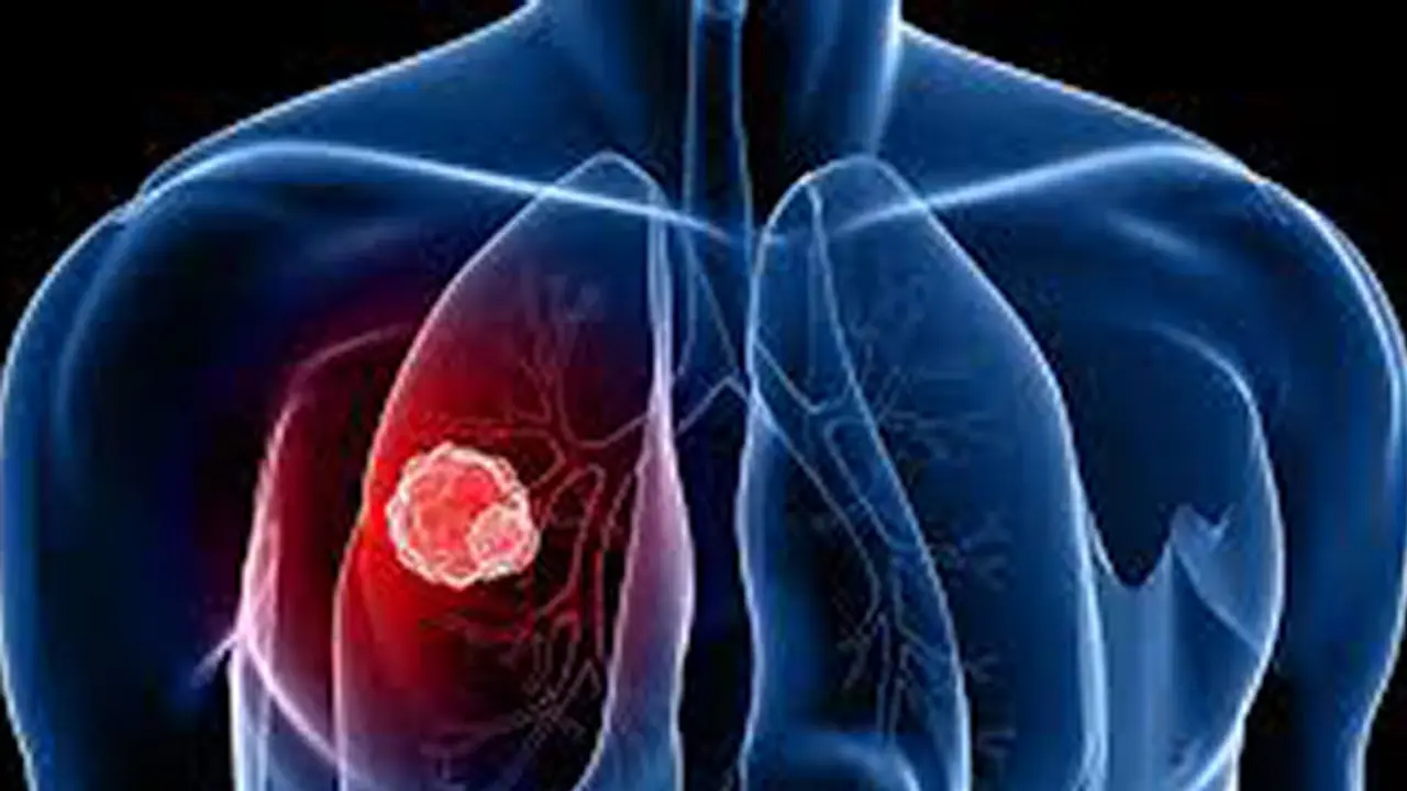 World Cancer Day 2022: এই কয়টি ভুলে বাড়ছে ফুসফুস ক্যান্সার, জেনে নিন কী করে মুক্তি পাবেন মারণ রোগ থেকে World Cancer Day 2022: এই কয়টি ভুলে বাড়ছে ফুসফুস ক্যান্সার, জেনে নিন কী করে মুক্তি পাবেন মারণ রোগ থেকে