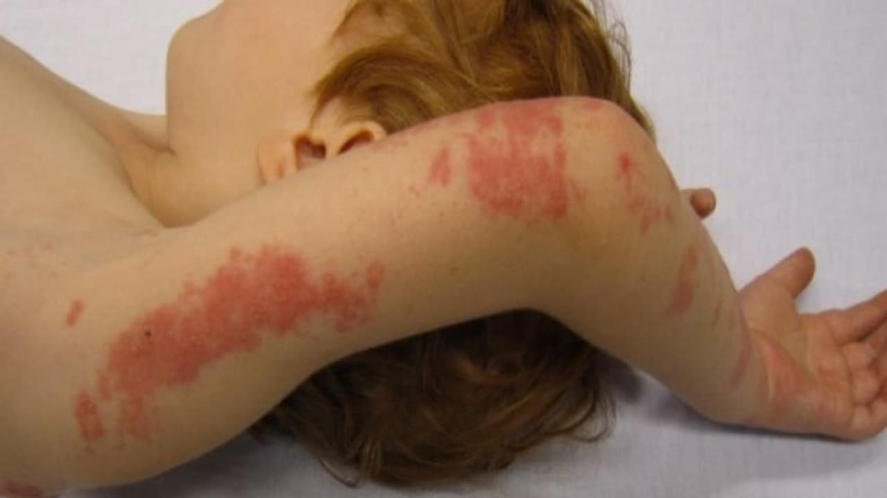 உங்களுக்குத் தெரியுமா? அம்மை நோய் முன்பு தாக்கியவர்களுக்குதான் அக்கி நோய் வருமாம்... உங்களுக்குத் தெரியுமா? அம்மை நோய் முன்பு தாக்கியவர்களுக்குதான் அக்கி நோய் வருமாம்...