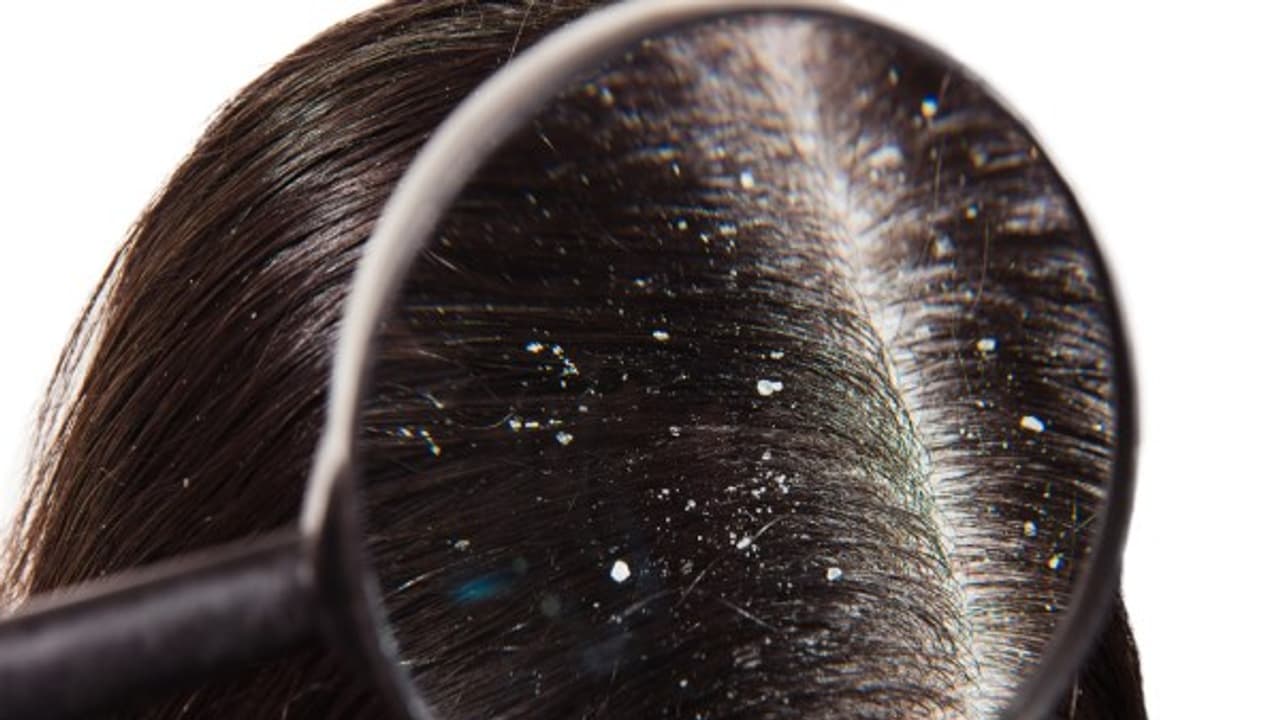 பொடுகை அடியோடு விரட்டும் சூப்பர் டிப்ஸ் ஒருமுறை பயன்படுத்தினாலே நல்ல ரிசல்ட் தெரியும்... பொடுகை அடியோடு விரட்டும் சூப்பர் டிப்ஸ் ஒருமுறை பயன்படுத்தினாலே நல்ல ரிசல்ட் தெரியும்...