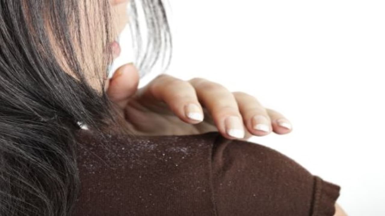 താരൻ അകറ്റണോ; വീട്ടിലുള്ള ഈ മൂന്ന് സാധനങ്ങള്‍ മതി