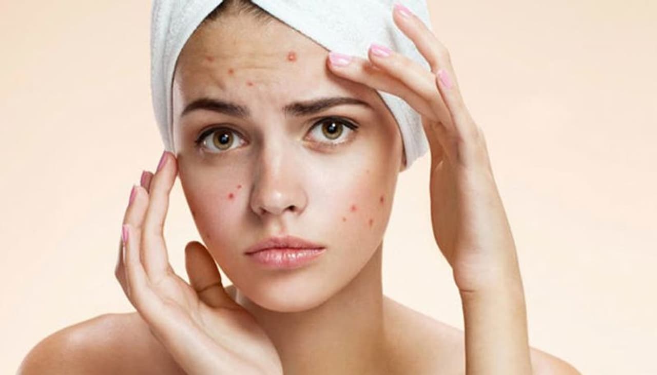 <p>వయసులో ఉన్న అమ్మాయిలందరినీ.. మొటిమల సమస్య వేధిస్తూనే ఉంటుంది. ఆ మొటిమలు తగ్గిన తర్వాత కూడా.. దాని తాలూకు మచ్చలు కూడా వేధిస్తూనే ఉంటాయి. </p> <p>వయసులో ఉన్న అమ్మాయిలందరినీ.. మొటిమల సమస్య వేధిస్తూనే ఉంటుంది. ఆ మొటిమలు తగ్గిన తర్వాత కూడా.. దాని తాలూకు మచ్చలు కూడా వేధిస్తూనే ఉంటాయి. </p>