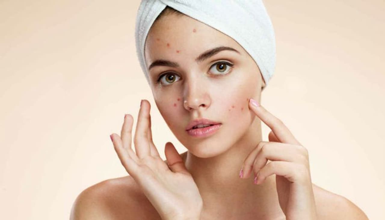 <p><br />Acne</p><p> </p><p>Have you ever wondered why you end up with a pimple on your face right before an exam or wedding? Well, that’s because of stress. When you’re facing anxiety, a hormone called cortisol gets released which causes glands to produce more oil.</p><p> </p><p>Remedy: Using tea tree oil kills bacteria. You can also use Benzoyl peroxide which opens up your pores.</p> <p><br />Acne</p><p> </p><p>Have you ever wondered why you end up with a pimple on your face right before an exam or wedding? Well, that’s because of stress. When you’re facing anxiety, a hormone called cortisol gets released which causes glands to produce more oil.</p><p> </p><p>Remedy: Using tea tree oil kills bacteria. You can also use Benzoyl peroxide which opens up your pores.</p>