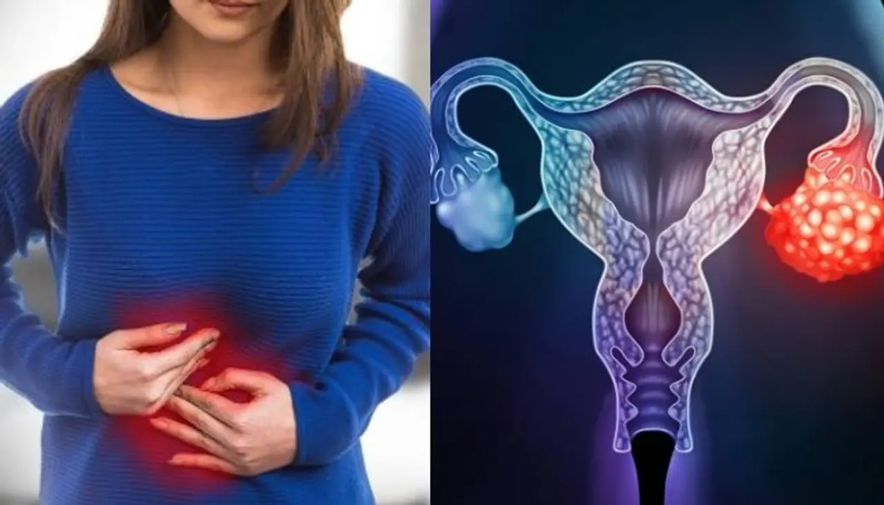 <p>ಅಂಡಾಶಯದ ಕ್ಯಾನ್ಸರ್ ಲಕ್ಷಣಗಳು ಆರಂಭಿಕ ಹಂತದಲ್ಲಿಯೇ ಪತ್ತೆಯಾದರೆ, ರೋಗಿಗೆ ಚಿಕಿತ್ಸೆ ನೀಡುವ ಮೂಲಕ ಗುಣಪಡಿಸಬಹುದು. ಅಂಡಾಶಯದಲ್ಲಿನ ಯಾವುದೇ ರೀತಿಯ ಸಿಸ್ಟ್, ಹುಣ್ಣನ್ನು ನಿರ್ಲಕ್ಷಿಸಿದರೆ ಗೆಡ್ಡೆ ರೂಪವನ್ನು ಪಡೆಯುತ್ತದೆ. ಅಂಡಾಶಯ ಗರ್ಭ ಧರಿಸುವಲ್ಲಿ ಬಹಳ ಮುಖ್ಯ ಪಾತ್ರ ವಹಿಸುತ್ತದೆ. </p> <p>ಅಂಡಾಶಯದ ಕ್ಯಾನ್ಸರ್ ಲಕ್ಷಣಗಳು ಆರಂಭಿಕ ಹಂತದಲ್ಲಿಯೇ ಪತ್ತೆಯಾದರೆ, ರೋಗಿಗೆ ಚಿಕಿತ್ಸೆ ನೀಡುವ ಮೂಲಕ ಗುಣಪಡಿಸಬಹುದು. ಅಂಡಾಶಯದಲ್ಲಿನ ಯಾವುದೇ ರೀತಿಯ ಸಿಸ್ಟ್, ಹುಣ್ಣನ್ನು ನಿರ್ಲಕ್ಷಿಸಿದರೆ ಗೆಡ್ಡೆ ರೂಪವನ್ನು ಪಡೆಯುತ್ತದೆ. ಅಂಡಾಶಯ ಗರ್ಭ ಧರಿಸುವಲ್ಲಿ ಬಹಳ ಮುಖ್ಯ ಪಾತ್ರ ವಹಿಸುತ್ತದೆ. </p>