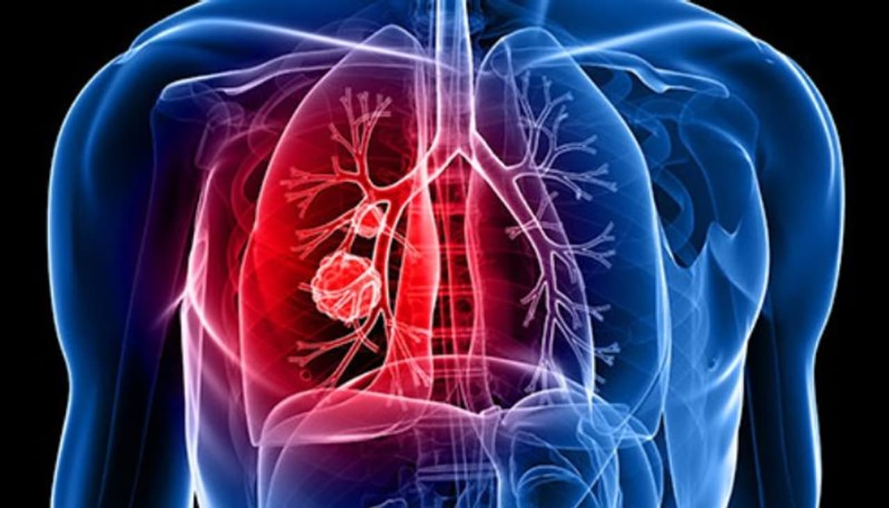 <p>ನಿರ್ದಿಷ್ಟ ಅಂಗದ ಜೀವಕೋಶಗಳ ಅಸಹಜ ಬೆಳವಣಿಗೆ ಇದ್ದಾಗ ಕ್ಯಾನ್ಸರ್ ಉಂಟಾಗುತ್ತದೆ, ಇದು ಅಂಗದ ಒಳಗೆ ಅಥವಾ ಹೊರಗೆ ಉಂಡೆಗಳ ರಚನೆಗೆ ಕಾರಣವಾಗುತ್ತದೆ. ಆ ಉಂಡೆಗಳು ನಂತರ ಗೆಡ್ಡೆಗಳನ್ನು ರೂಪಿಸುತ್ತವೆ. ಗೆಡ್ಡೆಗಳು ಎರಡು ವಿಧಗಳಾಗಿವೆ ಹಾನಿಕರವಲ್ಲದ ಮತ್ತು ಮಾರಕ. ಹಾನಿಕರವಲ್ಲದ ಗೆಡ್ಡೆಗಳು ಮಾರಣಾಂತಿಕವಲ್ಲ ಮತ್ತು ಅದನ್ನು ಗುಣಪಡಿಸಬಹುದು, ಆದರೆ ಮಾರಣಾಂತಿಕ ಗೆಡ್ಡೆಗಳು ಸಾವಿಗೆ ಕಾರಣವಾಗಬಹುದು. </p> <p>ನಿರ್ದಿಷ್ಟ ಅಂಗದ ಜೀವಕೋಶಗಳ ಅಸಹಜ ಬೆಳವಣಿಗೆ ಇದ್ದಾಗ ಕ್ಯಾನ್ಸರ್ ಉಂಟಾಗುತ್ತದೆ, ಇದು ಅಂಗದ ಒಳಗೆ ಅಥವಾ ಹೊರಗೆ ಉಂಡೆಗಳ ರಚನೆಗೆ ಕಾರಣವಾಗುತ್ತದೆ. ಆ ಉಂಡೆಗಳು ನಂತರ ಗೆಡ್ಡೆಗಳನ್ನು ರೂಪಿಸುತ್ತವೆ. ಗೆಡ್ಡೆಗಳು ಎರಡು ವಿಧಗಳಾಗಿವೆ ಹಾನಿಕರವಲ್ಲದ ಮತ್ತು ಮಾರಕ. ಹಾನಿಕರವಲ್ಲದ ಗೆಡ್ಡೆಗಳು ಮಾರಣಾಂತಿಕವಲ್ಲ ಮತ್ತು ಅದನ್ನು ಗುಣಪಡಿಸಬಹುದು, ಆದರೆ ಮಾರಣಾಂತಿಕ ಗೆಡ್ಡೆಗಳು ಸಾವಿಗೆ ಕಾರಣವಾಗಬಹುದು. </p>