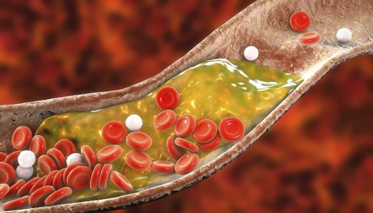 Bad Cholesterol Bad Cholesterol