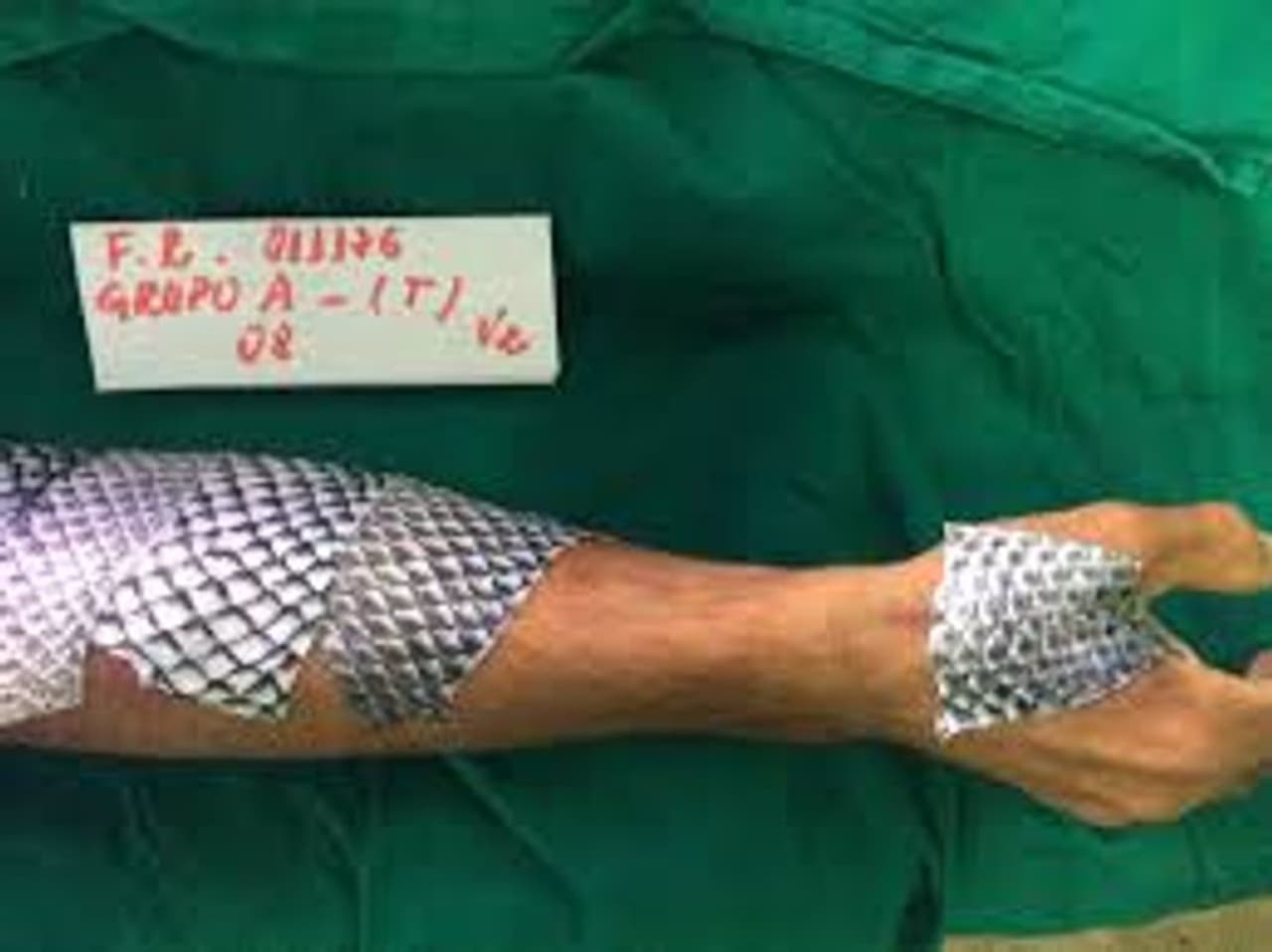 <p>திலாப்பியா (Tilapia) என்ற மீன் வகை ஒன்று உள்ளது. இதன் பூர்வீகம் ஆப்பிரிக்கா நாடாகும். நன்னீரில் வளரும் மீன் இனம் இது. தீக்காயங்களுக்கான சிகிச்சைக்காக பயன்படுத்தப்பட்டு வருகிறது. </p> <p>திலாப்பியா (Tilapia) என்ற மீன் வகை ஒன்று உள்ளது. இதன் பூர்வீகம் ஆப்பிரிக்கா நாடாகும். நன்னீரில் வளரும் மீன் இனம் இது. தீக்காயங்களுக்கான சிகிச்சைக்காக பயன்படுத்தப்பட்டு வருகிறது. </p>