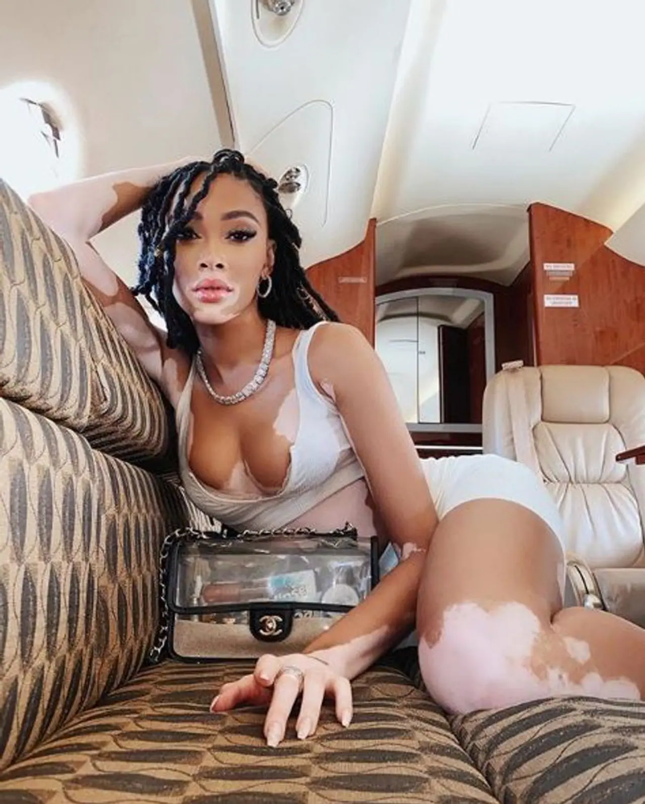 <p>ಈ ಕಪ್ಪು ಹುಡುಗಿಯ ಬಾಯಿಯ ಸುತ್ತ, ಹುಬ್ಬಿನ ಮೇಲೆ ಬಿಳಿ ಪ್ಯಾಚ್ಗಳು</p> <p>ಈ ಕಪ್ಪು ಹುಡುಗಿಯ ಬಾಯಿಯ ಸುತ್ತ, ಹುಬ್ಬಿನ ಮೇಲೆ ಬಿಳಿ ಪ್ಯಾಚ್ಗಳು</p>