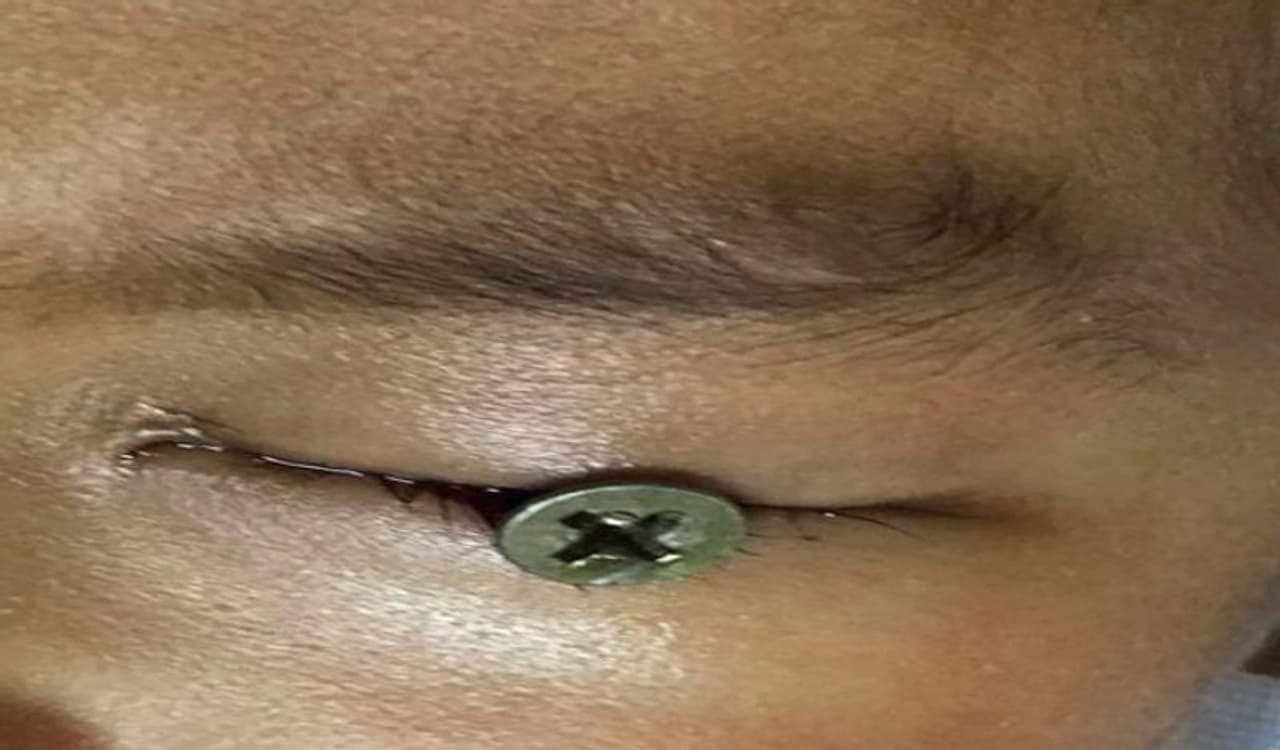 <p>ಈ ಶಾಕಿಂಗ್ ಘಟನೆ ಥಾಯ್ಲೆಂಡ್ನ ಖಾವೂಂನಲ್ಲಿ ನಡೆದಿದೆ. ಇಲ್ಲೊಬ್ಬ ಮೂರು ವರ್ಷದ ಮಗುವಿನ ಕಣ್ಣಿಗೆ ಕಬ್ಬಿಣದ ಮೊಳೆ ಚುಚ್ಚಿಕೊಂಡಿದೆ. ಈ ಘಟನೆಗೆ ತಂದೆಯ ಅಜಾಗರೂಕತೆಯೇ ಕಾರಣ ಎಂಬುವುದೂ ಬಹಿರಂಗವಾಗಿದೆ.</p> <p>ಈ ಶಾಕಿಂಗ್ ಘಟನೆ ಥಾಯ್ಲೆಂಡ್ನ ಖಾವೂಂನಲ್ಲಿ ನಡೆದಿದೆ. ಇಲ್ಲೊಬ್ಬ ಮೂರು ವರ್ಷದ ಮಗುವಿನ ಕಣ್ಣಿಗೆ ಕಬ್ಬಿಣದ ಮೊಳೆ ಚುಚ್ಚಿಕೊಂಡಿದೆ. ಈ ಘಟನೆಗೆ ತಂದೆಯ ಅಜಾಗರೂಕತೆಯೇ ಕಾರಣ ಎಂಬುವುದೂ ಬಹಿರಂಗವಾಗಿದೆ.</p>