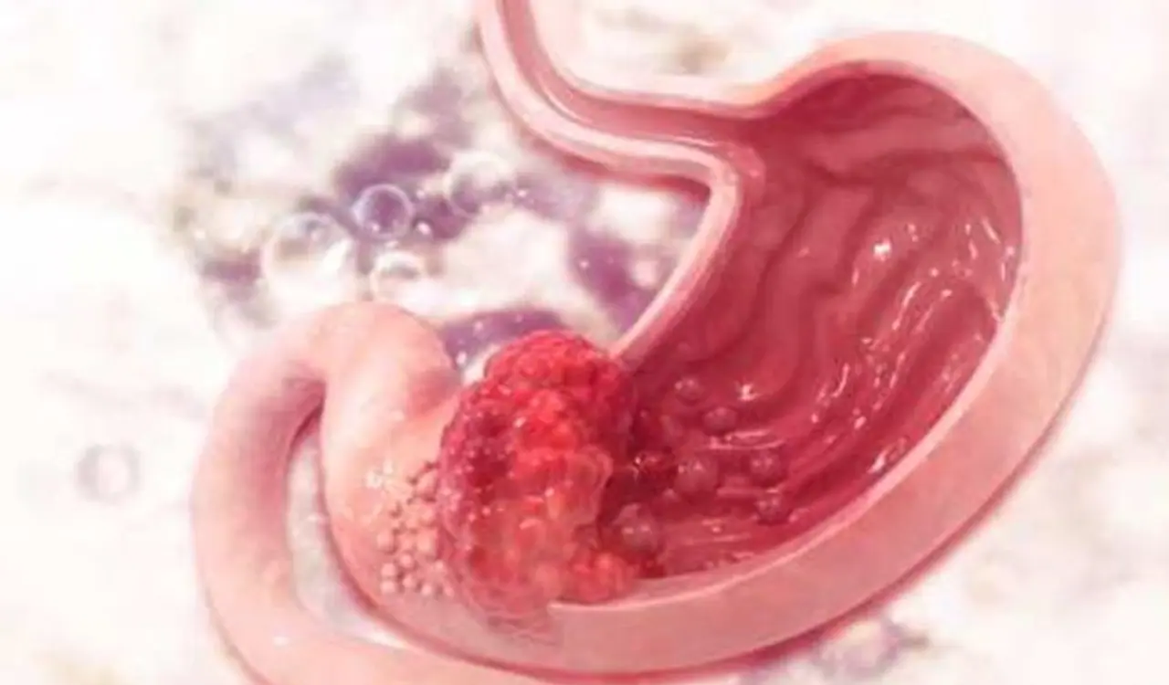 <p>ಮನುಷ್ಯರಿಗೆ ಈ ರೋಗ ತಗುಲಿದರೆ, ಹಲವು ಲಕ್ಷಣಗಳು ಕಾಣಿಸಿಕೊಳ್ಳುತ್ತವೆ. ಅವುಗಳಲ್ಲಿ ಈ ಸೋಂಕಿನ ಪ್ರಮುಖ ಲಕ್ಷಣಗಳು ಗುದ ಅಥವಾ ಯೋನಿ ಪ್ರದೇಶದ ತುರಿಕೆ, ನಿದ್ರಾಹೀನತೆ, ಕಿರಿಕಿರಿ, ಚಡಪಡಿಕೆ, ಹೊಟ್ಟೆ ನೋವು ಮತ್ತು ವಾಕರಿಕೆ.</p> <p>ಮನುಷ್ಯರಿಗೆ ಈ ರೋಗ ತಗುಲಿದರೆ, ಹಲವು ಲಕ್ಷಣಗಳು ಕಾಣಿಸಿಕೊಳ್ಳುತ್ತವೆ. ಅವುಗಳಲ್ಲಿ ಈ ಸೋಂಕಿನ ಪ್ರಮುಖ ಲಕ್ಷಣಗಳು ಗುದ ಅಥವಾ ಯೋನಿ ಪ್ರದೇಶದ ತುರಿಕೆ, ನಿದ್ರಾಹೀನತೆ, ಕಿರಿಕಿರಿ, ಚಡಪಡಿಕೆ, ಹೊಟ್ಟೆ ನೋವು ಮತ್ತು ವಾಕರಿಕೆ.</p>