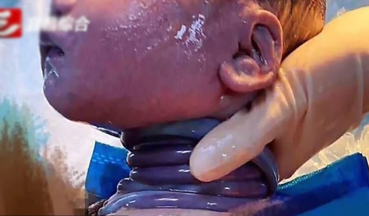 <p>ಈ ಘಟನೆ ಚೀನಾದಲ್ಲಿ ನಡೆದಿದೆ. ಇಲ್ಲಿನ ಹುಬೇಯಿ ಪ್ರಾತ್ಯಂದ ಆಸ್ಪತ್ರೆಯೊಂದರಲ್ಲಿ ವೈದ್ಯರು ನವಜಾತ ಶಿಶುವನ್ನು ಶಾಕಿಂಗ್ ಸ್ಥಿತಿಯಲ್ಲಿ ಹೊರಗೆಳೆದಿದ್ದಾರೆ. ಈ ಮಗುವಿನ ಕತ್ತಿನ ಸುತ್ತ ಗರ್ಭದಲ್ಲೇ ಗರ್ಭನಾಳ ಬಿಗಿಯಾಗಿ ಸುತ್ತಿಕೊಂಡಿತ್ತು.</p> <p>ಈ ಘಟನೆ ಚೀನಾದಲ್ಲಿ ನಡೆದಿದೆ. ಇಲ್ಲಿನ ಹುಬೇಯಿ ಪ್ರಾತ್ಯಂದ ಆಸ್ಪತ್ರೆಯೊಂದರಲ್ಲಿ ವೈದ್ಯರು ನವಜಾತ ಶಿಶುವನ್ನು ಶಾಕಿಂಗ್ ಸ್ಥಿತಿಯಲ್ಲಿ ಹೊರಗೆಳೆದಿದ್ದಾರೆ. ಈ ಮಗುವಿನ ಕತ್ತಿನ ಸುತ್ತ ಗರ್ಭದಲ್ಲೇ ಗರ್ಭನಾಳ ಬಿಗಿಯಾಗಿ ಸುತ್ತಿಕೊಂಡಿತ್ತು.</p>