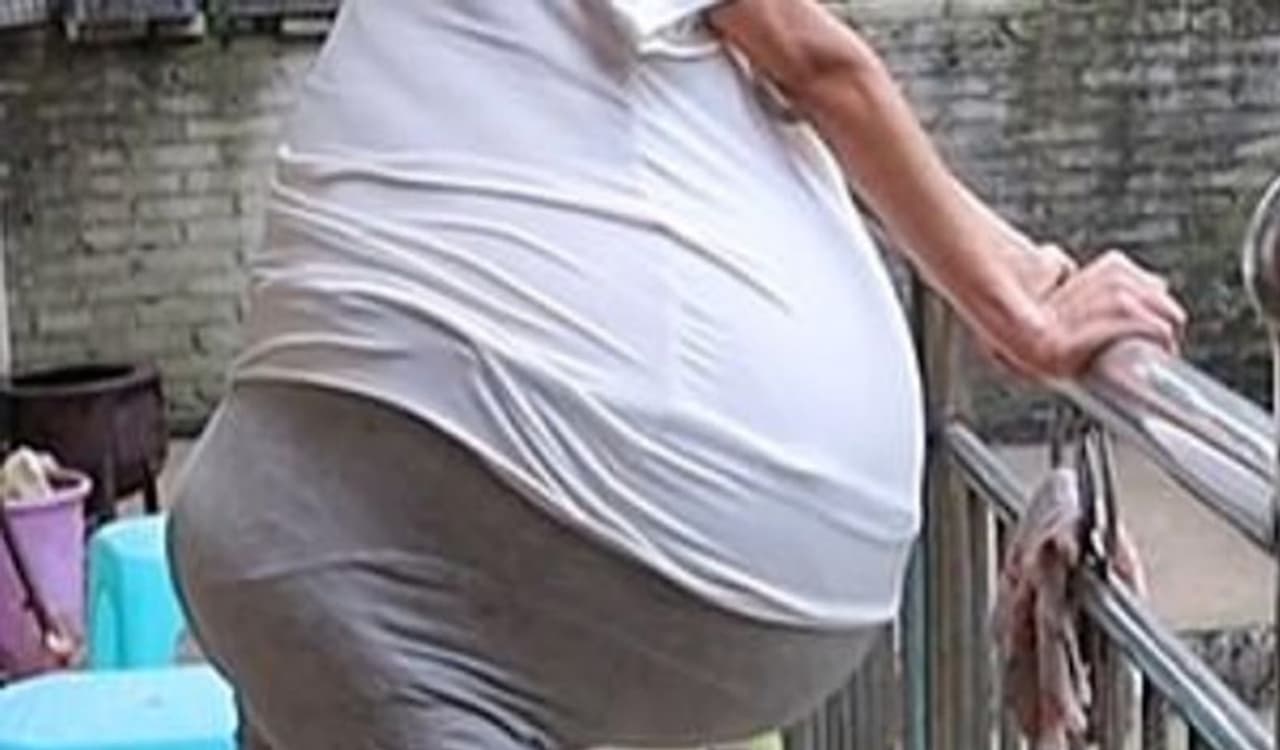 <p>சீனாவை சேர்ந்த இந்த பெண் தான் வித்தியாசமாக வயிறு வீங்கி கொண்டே போகும் நோயால் நாளுக்கு நாள் அவதி பட்டு வருகிறார்.<br />&nbsp;</p>