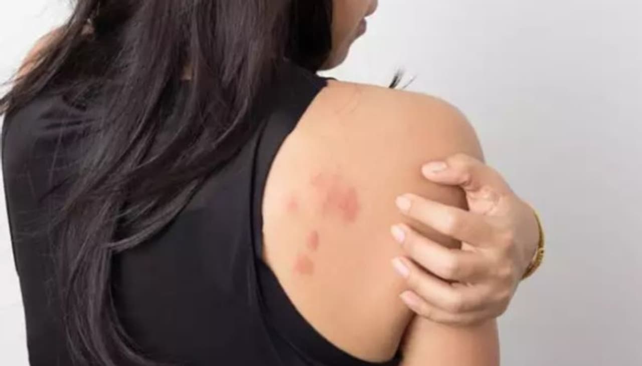 <p>&nbsp;</p><p>അല്‍പം പരന്ന്, 'വെല്‍വെറ്റ്' പരുവത്തില്‍ തൊലിപ്പുറത്ത് കാണപ്പെടുന്ന പാടും പ്രമേഹത്തിന്റെ സൂചനയാകാം. കഴുത്തിലോ കക്ഷത്തിലോ ഇതിന് സമീപമായോ ഒക്കെയാണ് സാധാരണഗതിയില്‍ ഈ പാടുണ്ടാകാറ്.&nbsp;</p><p>&nbsp;</p>